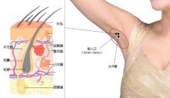 夏季来了你的狐臭有救了